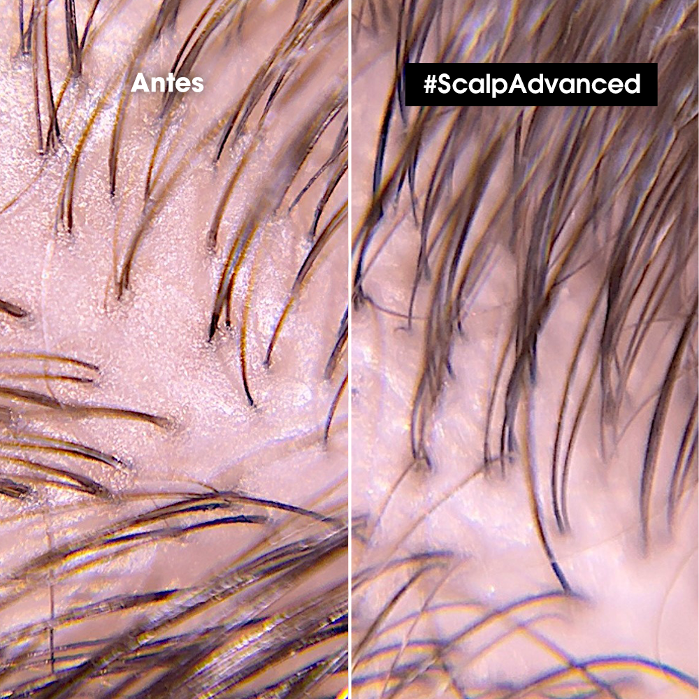 L'Oreal Pro  | Shampoo Scalp Advanced Anti grasa Loreal professionnel 300 ml