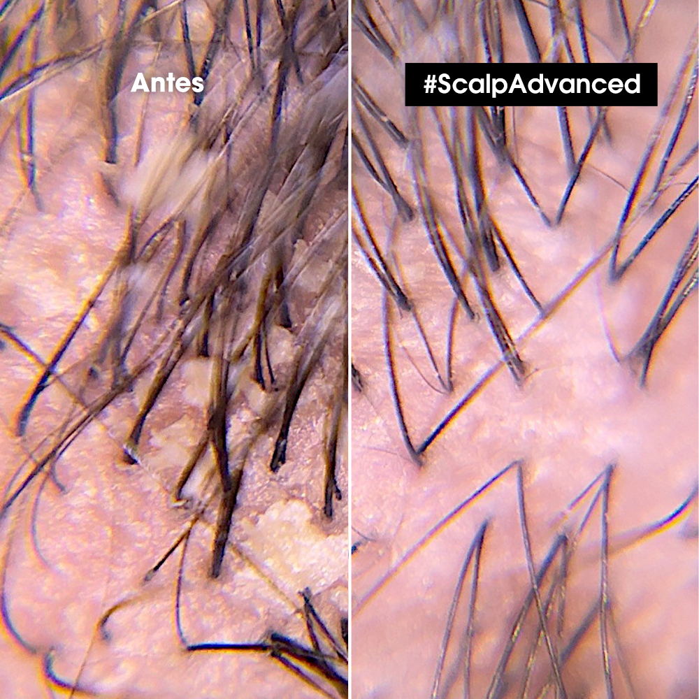 L'Oreal Pro  | Shampoo Scalp Advanced Anti caspa 300 Loreal professionnel ml