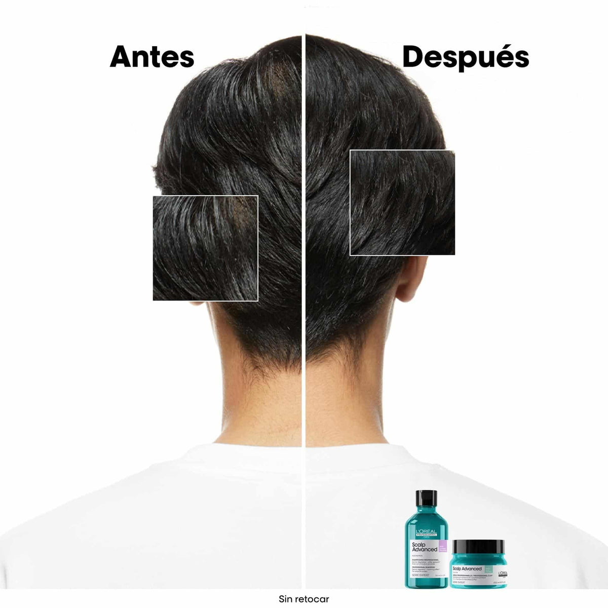 Shampoo Anti Grasa L'Oréal Professionel Scalp 300ml