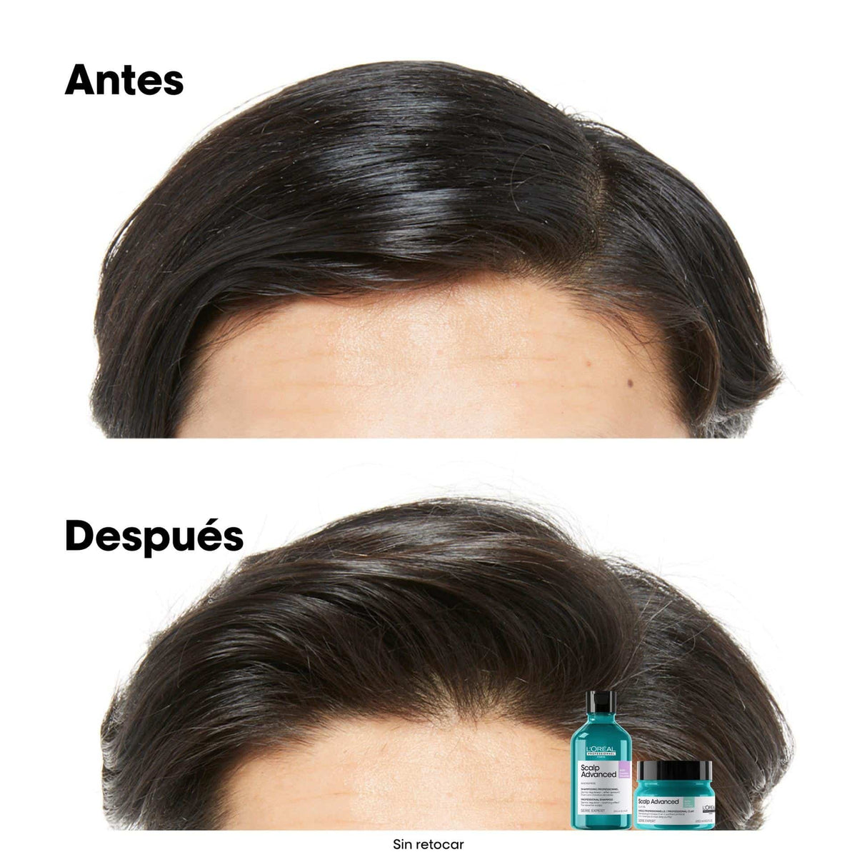 Shampoo Anti Grasa L'Oréal Professionel Scalp 300ml